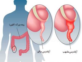 علائم التهاب آپاندیس