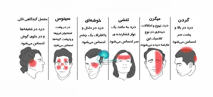 انواع سر درد